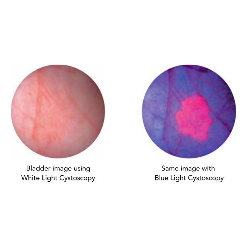 two circular images of bladders side by side. One is pink with a slight deviation in the center, displaying a bladder image using white light cystoscopy. The other on the right is the same image with a slight blue hue and a bright pink spot that is much more distinctive, displaying the same image with blue light cystoscopy